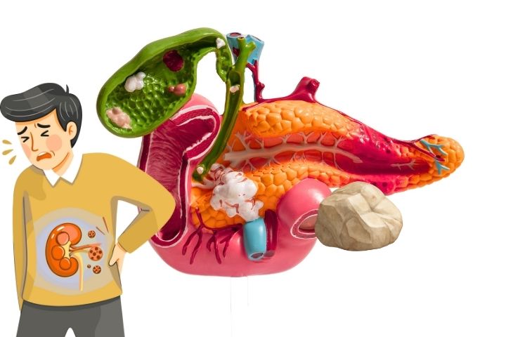 Pancreas stone surgery haryana